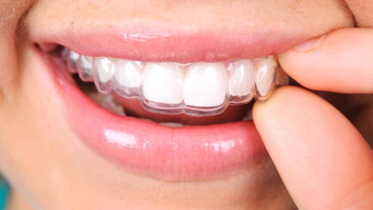 Ortodonti Tedavisinde Evde Acil Müdahaleler Nasıl Yapılır? Ortodonti Tedavisinde Evde Acil Müdahaleler Nasıl Yapılır?