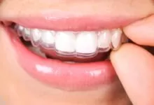 Ortodonti Tedavisinde Evde Acil Müdahaleler Nasıl Yapılır? 