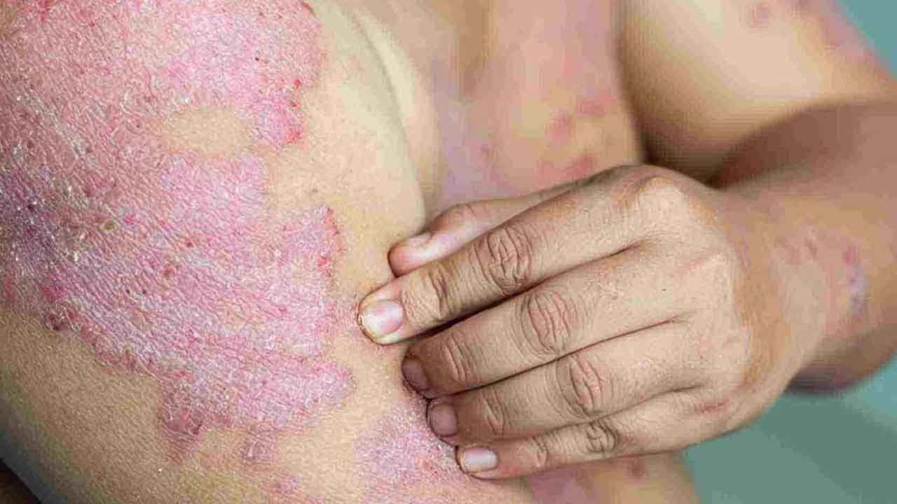 Tifo Hastalığı: Belirtileri, Tedavisi ve Önleme Yöntemleri  